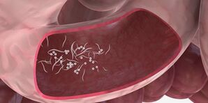 L'uso di terzine per rimuovere i parassiti
