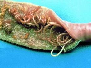 Le cause dei parassiti nel corpo umano