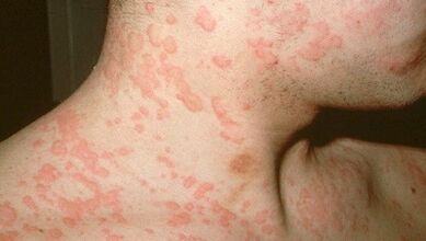 Quali parassiti nel corpo possono causare allergie